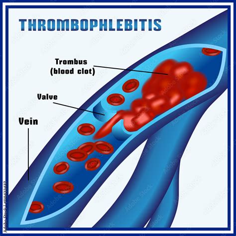 clotsiti|Thrombophlebitis .